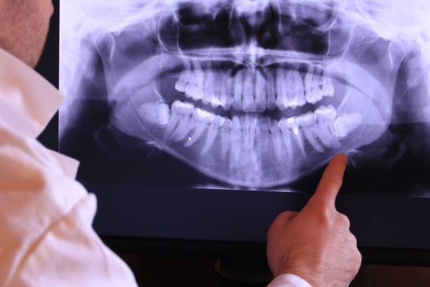 Best Dental Abscess Treatment in Troy Hills, NJ